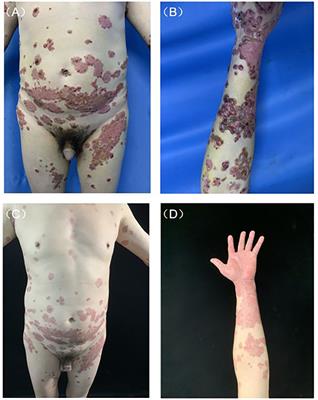 Case report: Dupilumab: a promising treatment option for adult linear IgA bullous dermatosis with severe pruritus